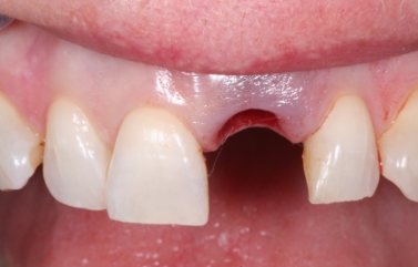Missing upper front tooth