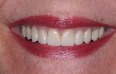 Smile with more evenly spaced teeth
