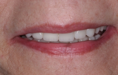Smile with whiter and newly restored teeth