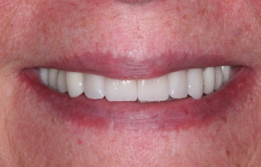 Smile with newly restored pearly whites