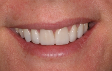 Smile after straightening and whitening the teeth