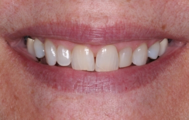 Smile with minor gaps between some of the teeth