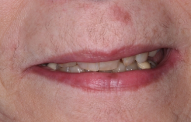 Smile with yellowed and worn teeth