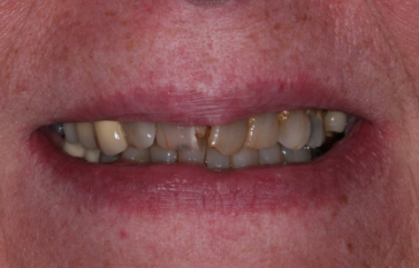 Smile with significantly damaged and discolored teeth