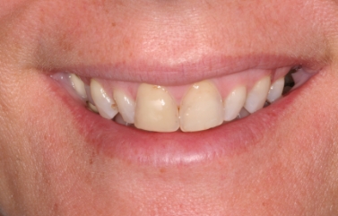 Smile with slightly misaligned and yellowed teeth