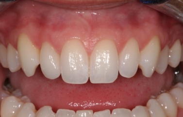 Smile with a new single tooth replacement