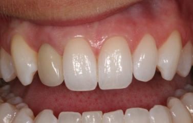 Smile before getting a single missing tooth replaced