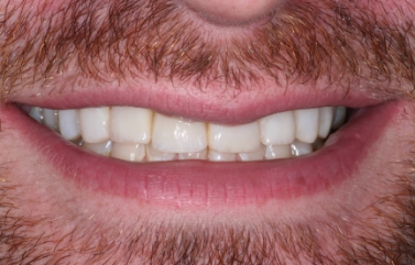 Man smiling with whiter teeth