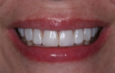 Woman smiling with whiter teeth