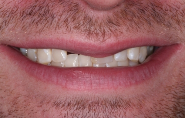 Man smiling with slightly yellowed teeth