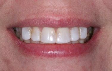 Woman smiling with yellow stains on her teeth