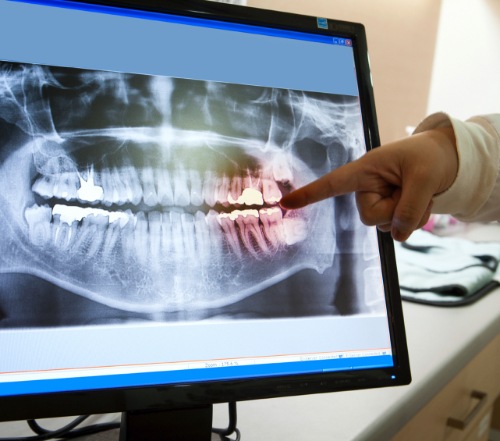 Panoramic dental x-rays on computer screen