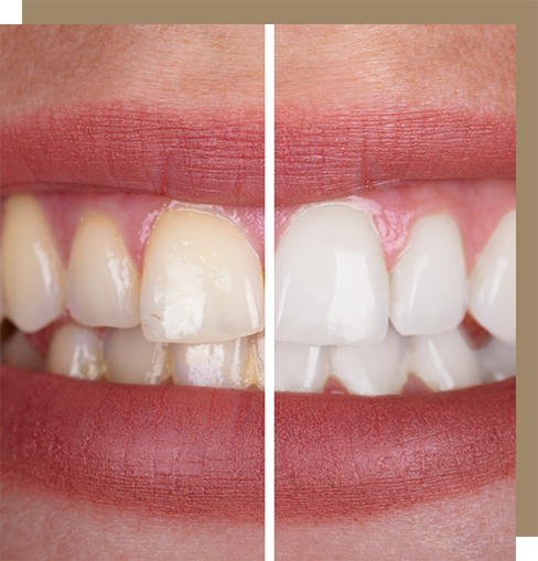 Close-up of a smile before and after teeth whitening in Cocoa Beach