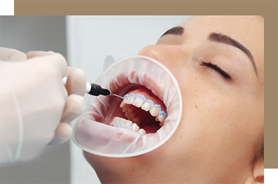Woman getting her teeth whitened at the dentist