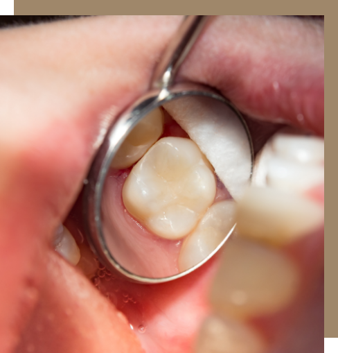 Close-up of a dental mirror reflecting a flawless tooth