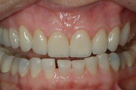 Flawless smile after porcelain veneers