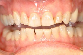 Yellowed and imperfect smile before porcelain veneers