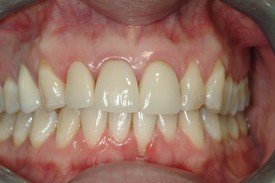 Imperfect smile before porcelain veneers