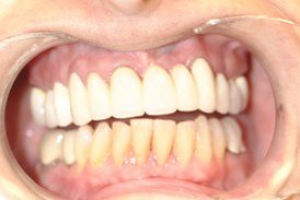 Yellowed bottom front teeth before porcelain veneers