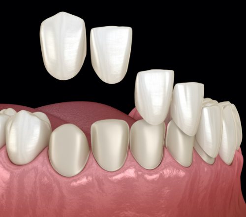 Animated smile during porcelain veneer placement