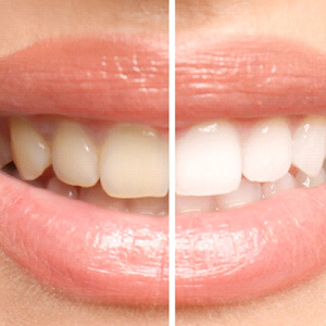 patients smile before and after teeth whitening