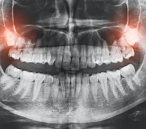 Dental x-ray showing impacted wisdom teeth