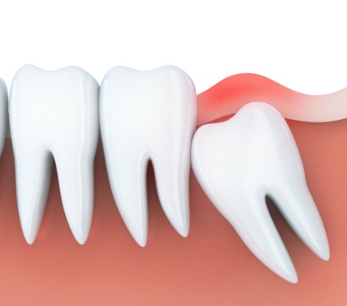 Animated smile with an impacted wisdom tooth