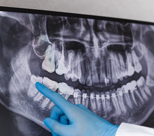 : A dentist pointing to a wisdom tooth on an X-ray