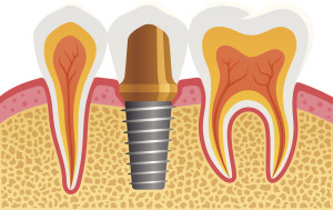 How can you replace 1, 2, or a whole row of teeth without dentures? With a dental implant in Cocoa Beach, FL, we can restore your grin. 