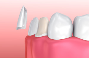 Your cosmetic dentist will improve your smile with porcelain veneers.