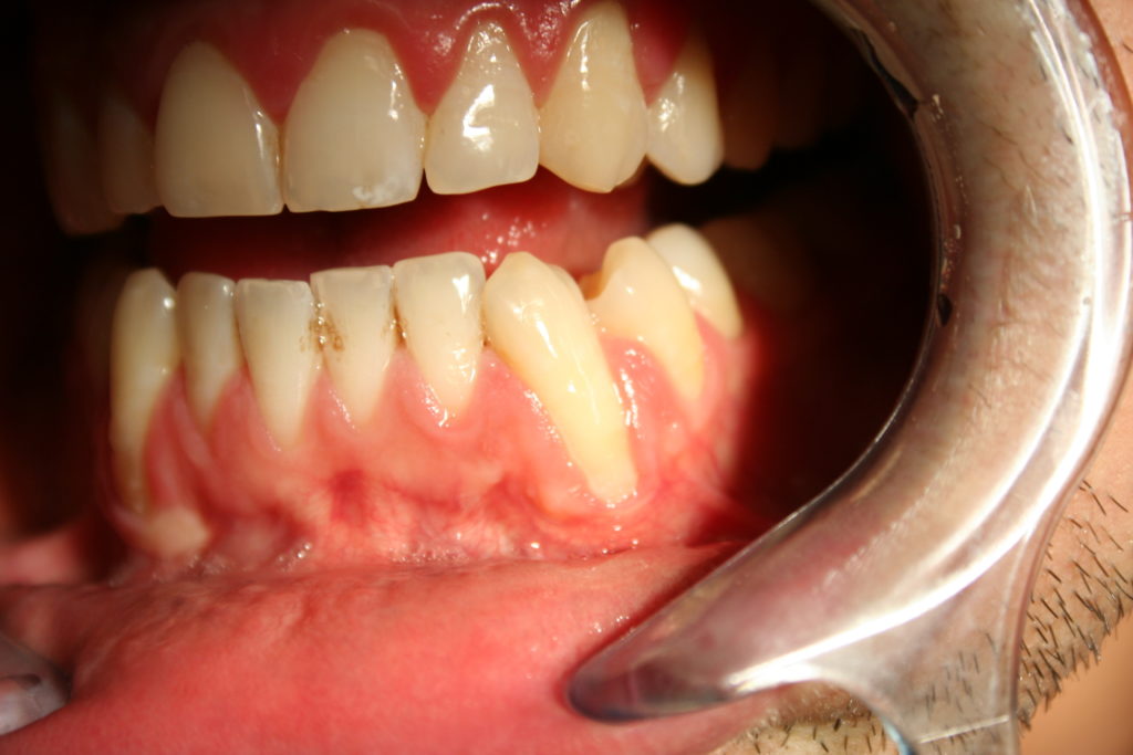 Up-close view of gum recession