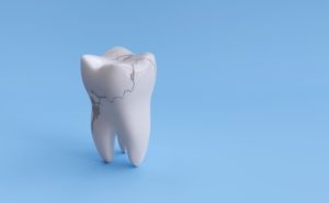 model of tooth enamel cracking