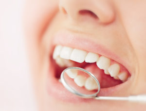 Closeup of patient with tooth-colored fillings