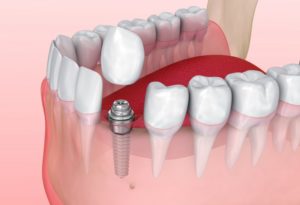 digital illustration of dental implants in Cocoa Beach