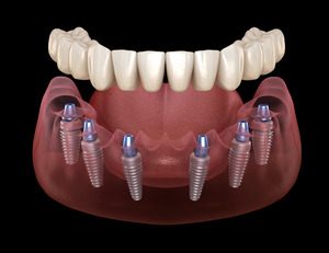 Illustration of a denture supported by dental implants