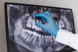 Dental x-ray shown.